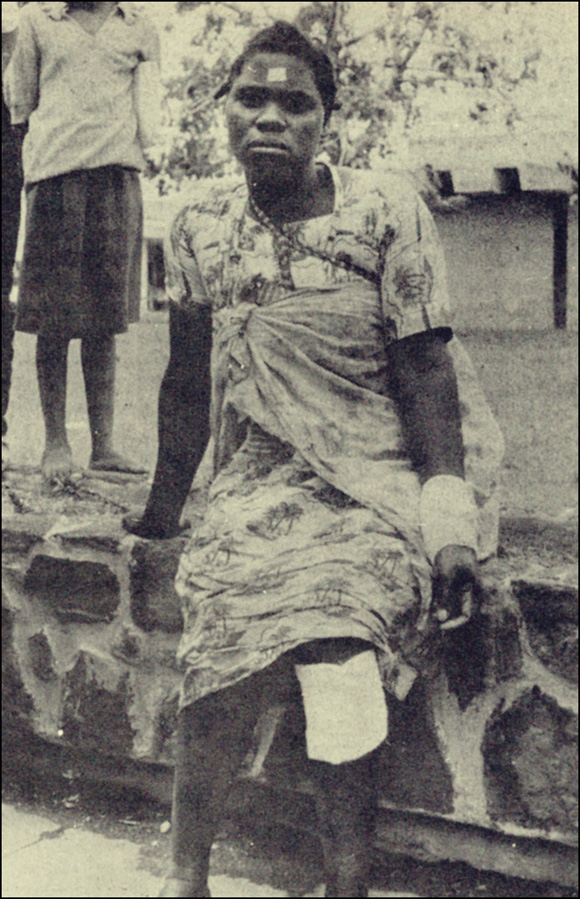 Injured rural woman, Mozambique, 1980s
